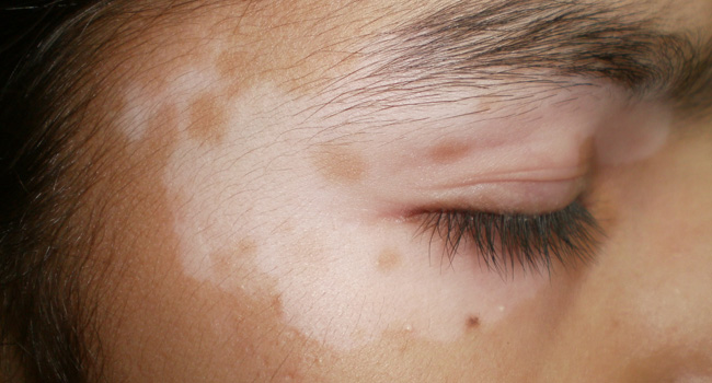 LEUCODERMA